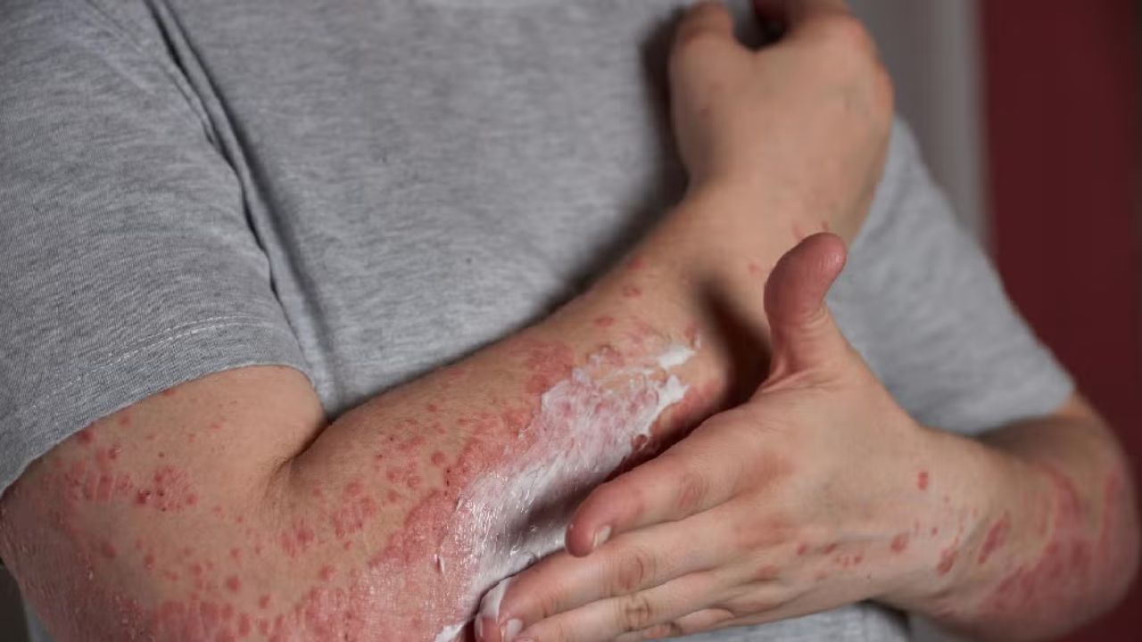 Imagen de ¿Honduras ha registrado casos de rubéola en 2025? Esto explicaron autoridades