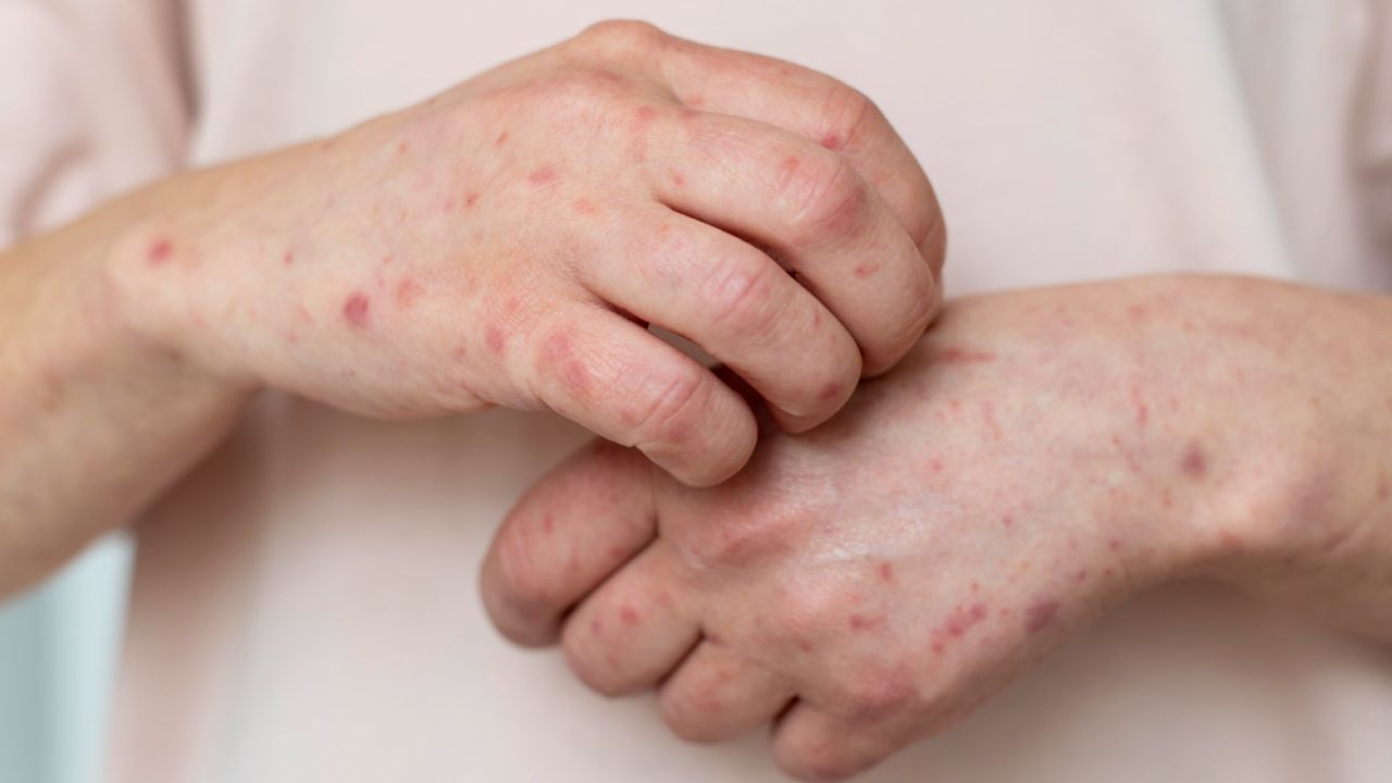 ¿Son lo mismo sarampión y varicela? ¿Cuáles son los síntomas de ambas?
