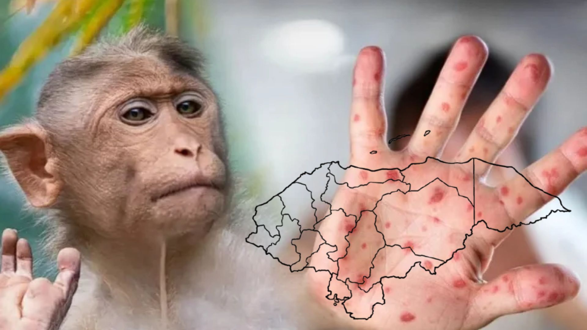 Salud confirma dos contagios de viruela símica: ¿cómo llegó la enfermedad a Honduras?