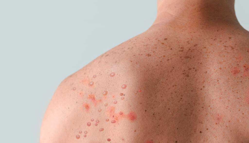 Una persona con sarampión