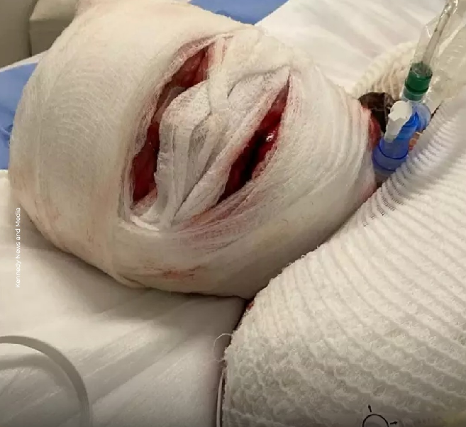 Imagen de Aleshia Rogers durante el coma al que fue inducida. Foto: Kennedy News and Media.