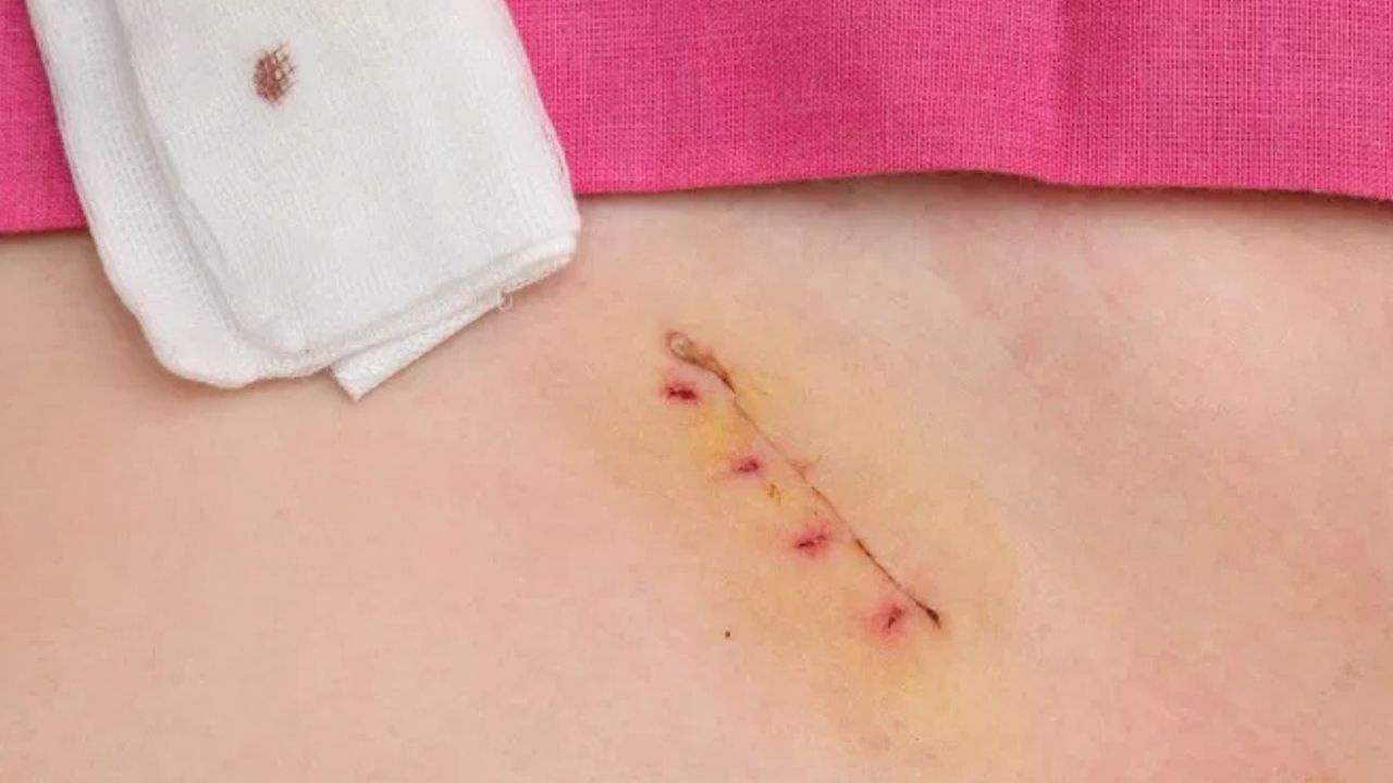 'Está engusanado', familia de hondureño denuncia herida infectada; hospital aclara