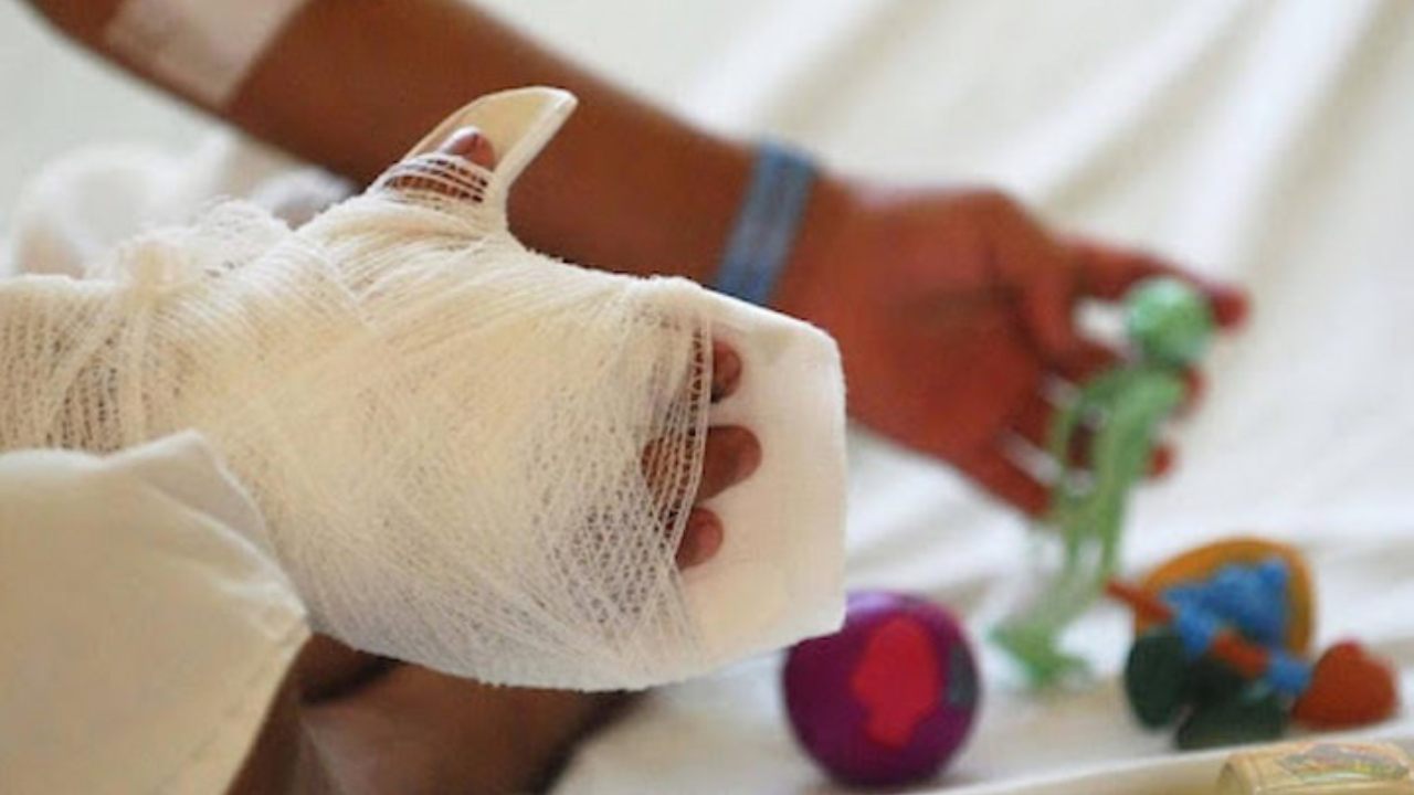Amputan la mano a adolescente tras explotarle varilla de pólvora en Intibucá