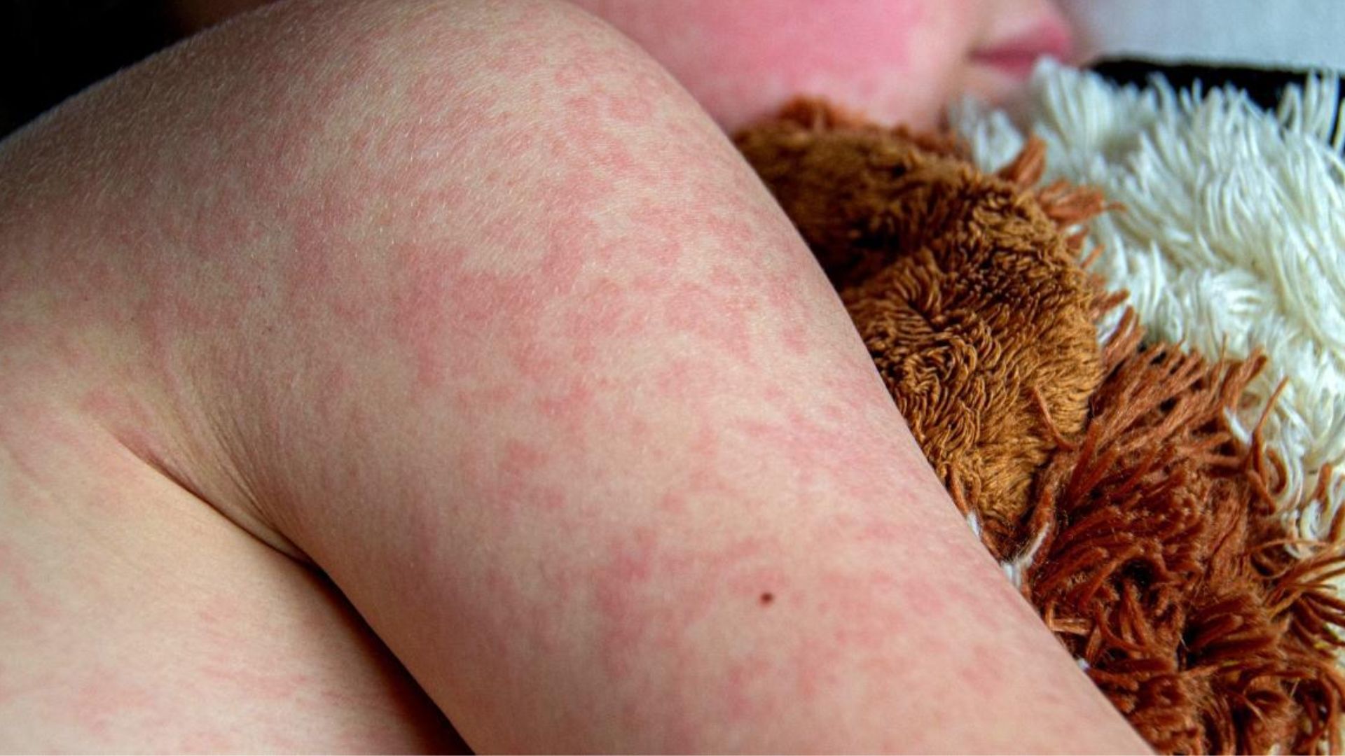 Cuatro hondureños bajo vigilancia por sospecha de sarampión