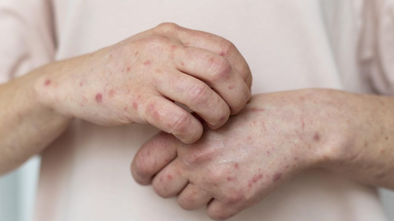 Imagen de Honduras refuerza vigilancia sanitaria tras brote de sarampión en evento religioso