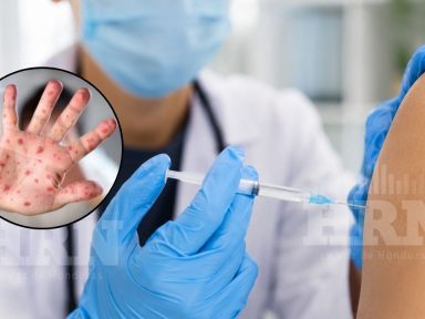 Imagen de Salud confirma nuevo caso de sarampión: pide vacunarse antes de viajar al Mundial