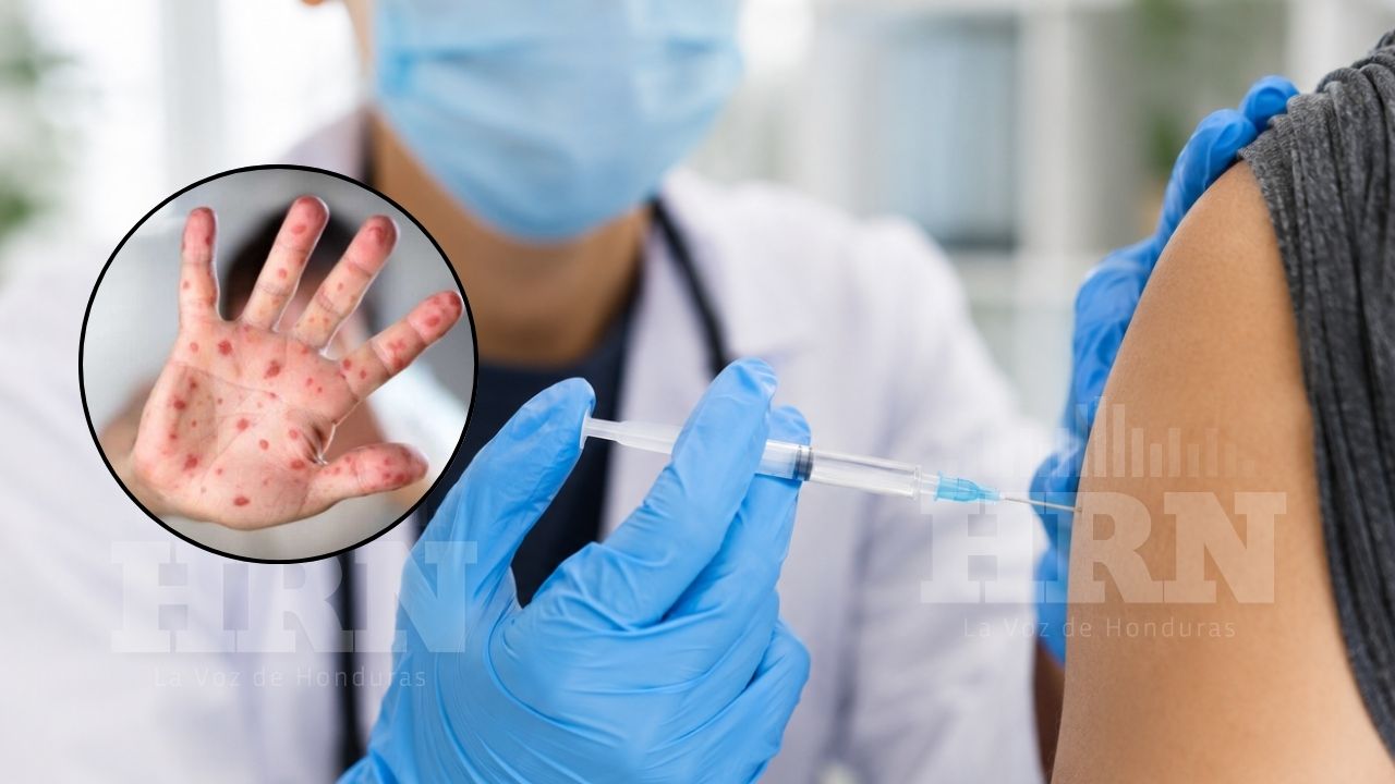 Salud confirma nuevo caso de sarampión: pide vacunarse antes de viajar al Mundial Imagen principal de Salud confirma nuevo caso de sarampión: pide vacunarse antes de viajar al Mundial