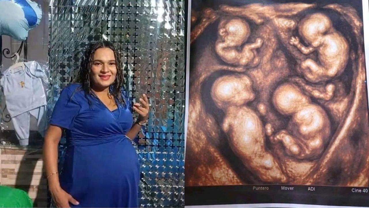 ¿Cuatro bebés idénticos?: El inusual embarazo de cuatrillizos que sorprende en Colombia Imagen principal de ¿Cuatro bebés idénticos?: El inusual embarazo de cuatrillizos que sorprende en Colombia
